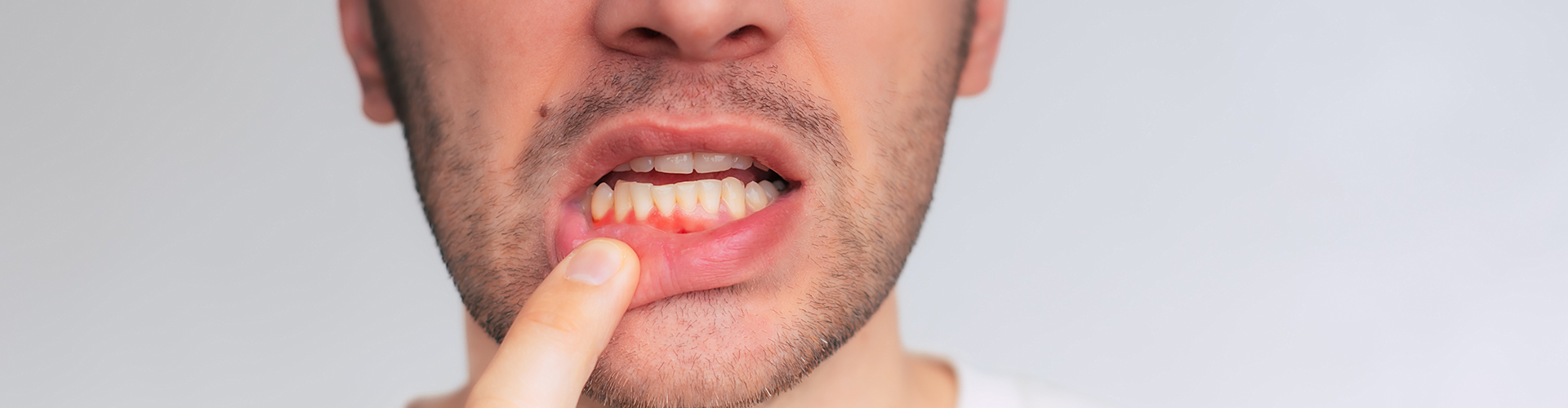 man pulling down lip to reveal inflamed gums